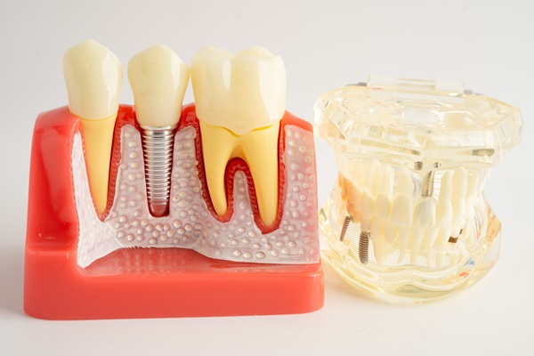 Why Choose Dental Implants Over A Dental Bridge?